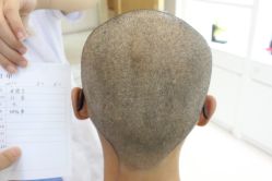 点击看大图 -大麦微针植发丨全国连锁