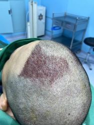 -大麦微针植发全国连锁