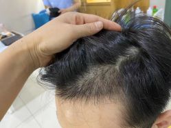 -大麦微针植发全国连锁