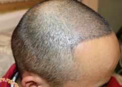 -大麦微针植发丨全国连锁