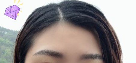 -大麦微针植发丨全国连锁