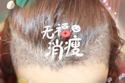 -大麦微针植发全国连锁