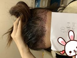 点击看大图 -大麦微针植发丨全国连锁