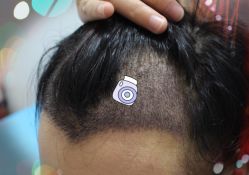 -大麦微针植发全国连锁