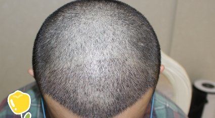 -大麦微针植发丨全国连锁