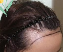 点击看大图 -大麦微针植发全国连锁