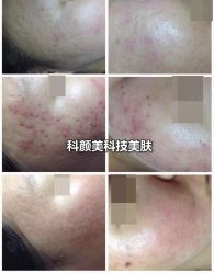 -美肤盾祛痘·问题肌头疗管理中心