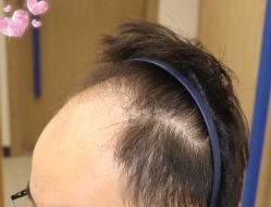 -大麦微针植发全国连锁