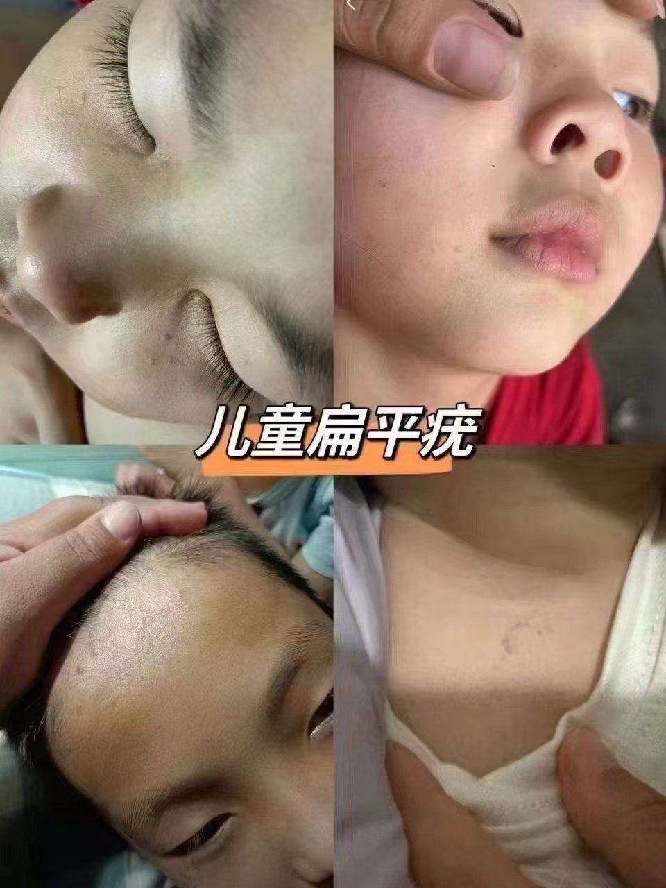 ✨为什么就连小孩都有疣?