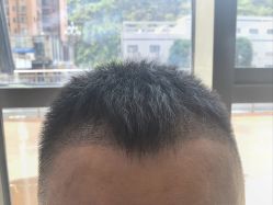 -碧莲盛·不剃发植发