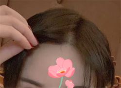 点击看大图 -大麦微针植发全国连锁