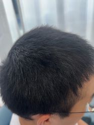 -大麦微针植发丨全国连锁