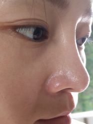 点击看大图 体验后-蕾特恩专业祛痘·皮肤管理