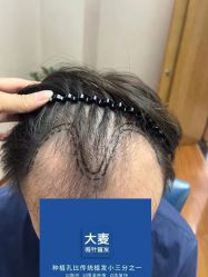 体验前-大麦微针植发全国连锁