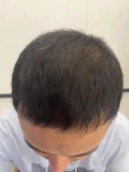 体验后-大麦微针植发全国连锁