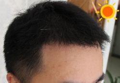 -大麦微针植发丨全国连锁