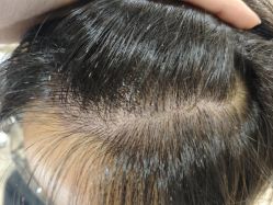 -碧莲盛·不剃发植发