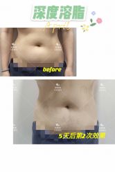 -苗塑堂减肥·艾灸