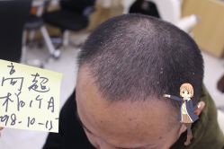 -大麦微针植发丨全国连锁