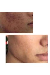 -痘博士烟台·全国连锁祛痘机构