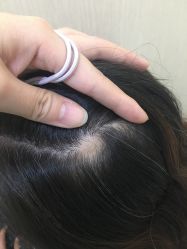 -碧莲盛·不剃发植发