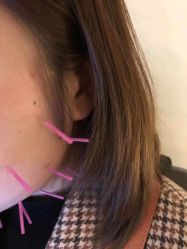 -肥三针腧穴瘦身馆