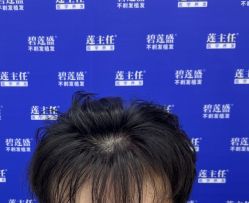 -碧莲盛·不剃发植发