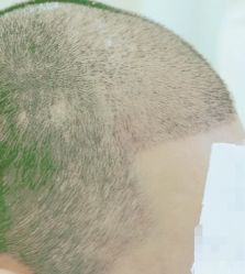 -大麦微针植发丨全国连锁