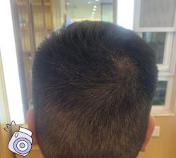 -大麦微针植发丨全国连锁