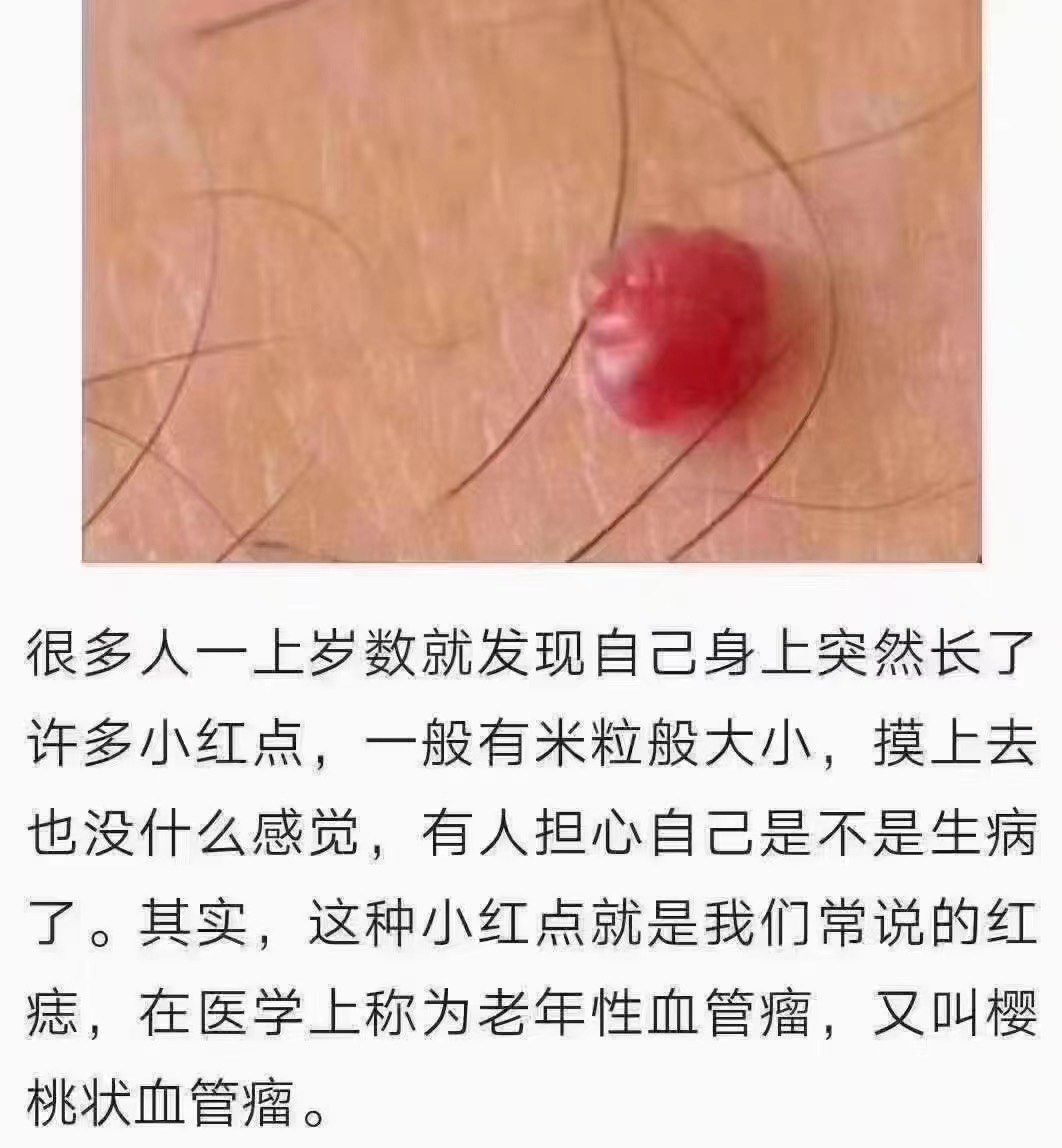 关于红血痣