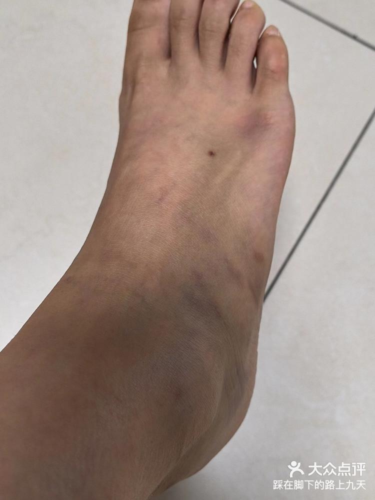 脚踝扭伤久治不愈反复发作