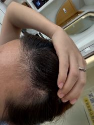 -大麦微针植发丨全国连锁