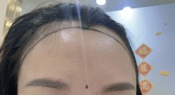 -碧莲盛·不剃发植发