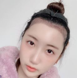 -碧莲盛·不剃发植发