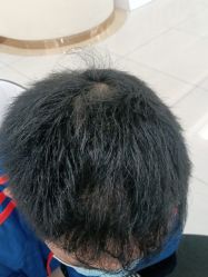 点击看大图 -新生植发·植养护一体