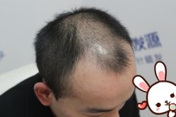 点击看大图 -大麦微针植发丨全国连锁