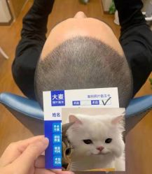 -大麦微针植发全国连锁