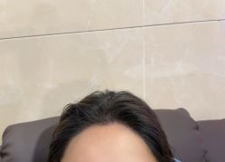 -碧莲盛·不剃发植发