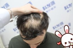 -大麦微针植发丨全国连锁