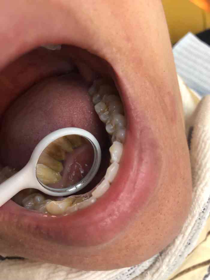 郑虹口腔-"【项目】洗牙去了补了些钱换了一个好点的.