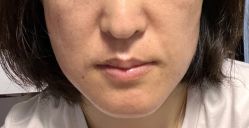 体验前-海涛医疗美容·面部抗衰·注射美鼻