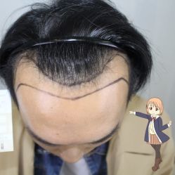 -大麦微针植发丨全国连锁