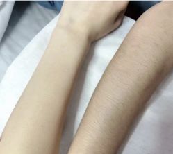 -薇兰专业脱毛连锁机构