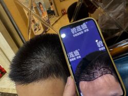 -碧莲盛·不剃发植发