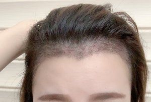 -大麦微针植发全国连锁