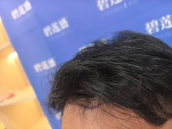 -碧莲盛不剃发植发