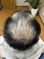 体验前-大麦微针植发全国连锁