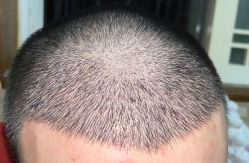 体验后-大麦微针植发全国连锁