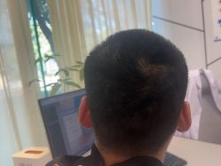 -碧莲盛·不剃发植发