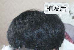 -大麦微针植发全国连锁